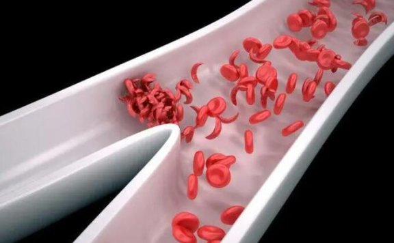 红斑狼疮被称“不死的癌症”，偏爱女性，累及全身！这些临床表现要知晓